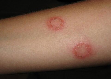 شناسایی ۱۶۰ بیمار مبتلا به سالک در حوزه دانشگاه علوم پزشکی مشهد